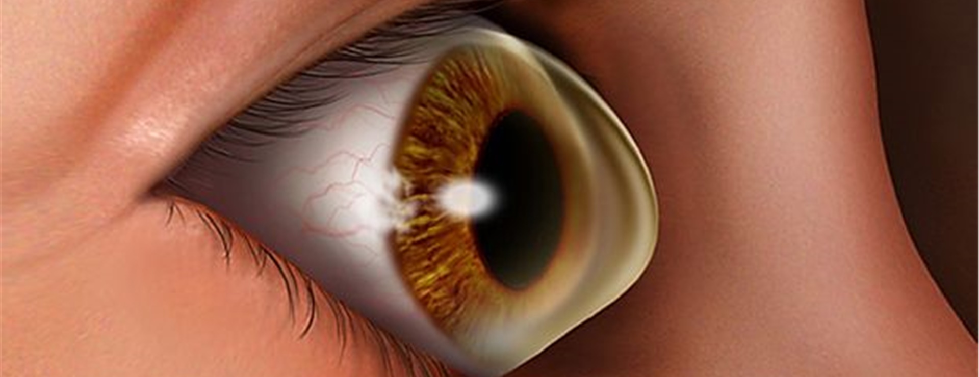 Wat is keratoconus?