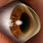 Wat is keratoconus?